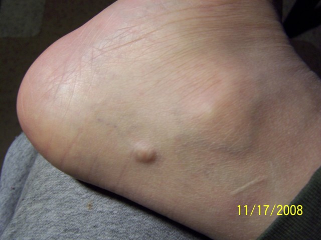 Lump On Lower Outside Of My Foot Podiatry