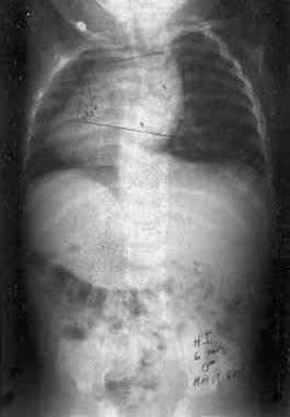 This anteroposterior radiograph of the spine in a 