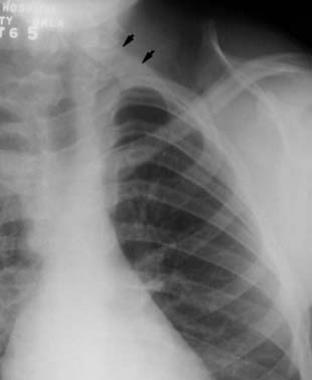 This radiograph demonstrates an omovertebral bone 