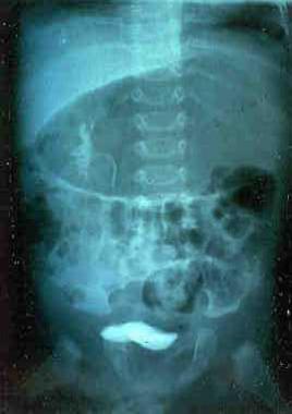 This intravenous pyelogram was performed before ul